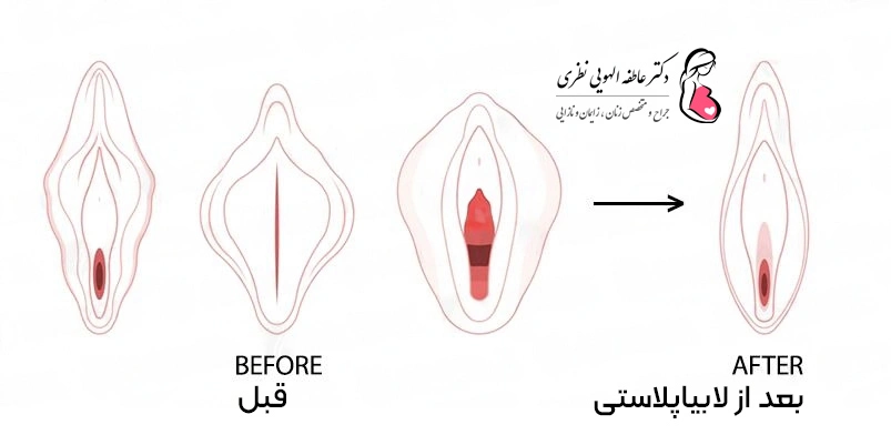 لابیاپلاستی قبل و بعد