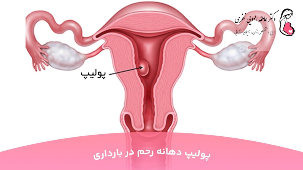 پولیپ دهانه رحم در بارداری