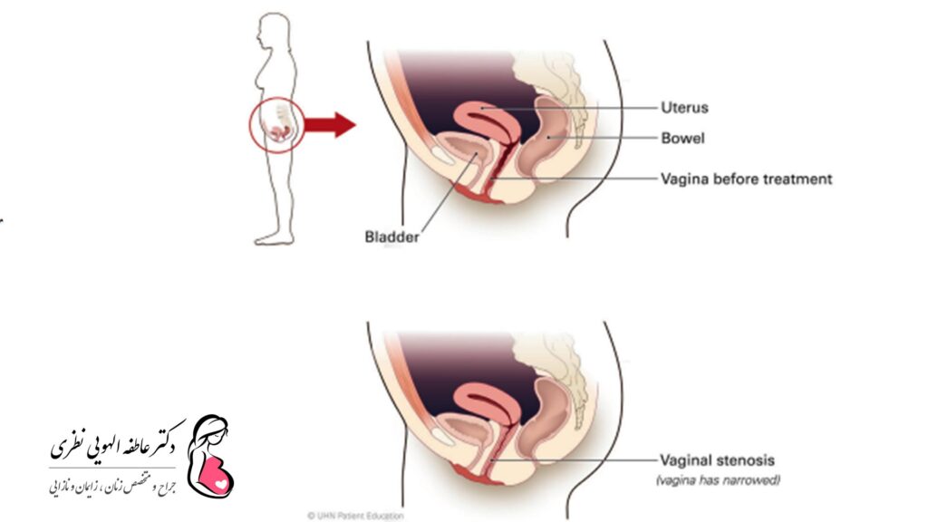 استنوزیس واژن چیست