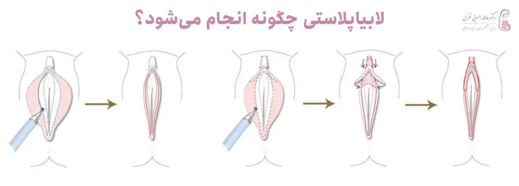 روش انجام لابیاپلاستی واژن