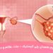 سندرم تخمدان پلی کیستیک - علت، علائم و درمان