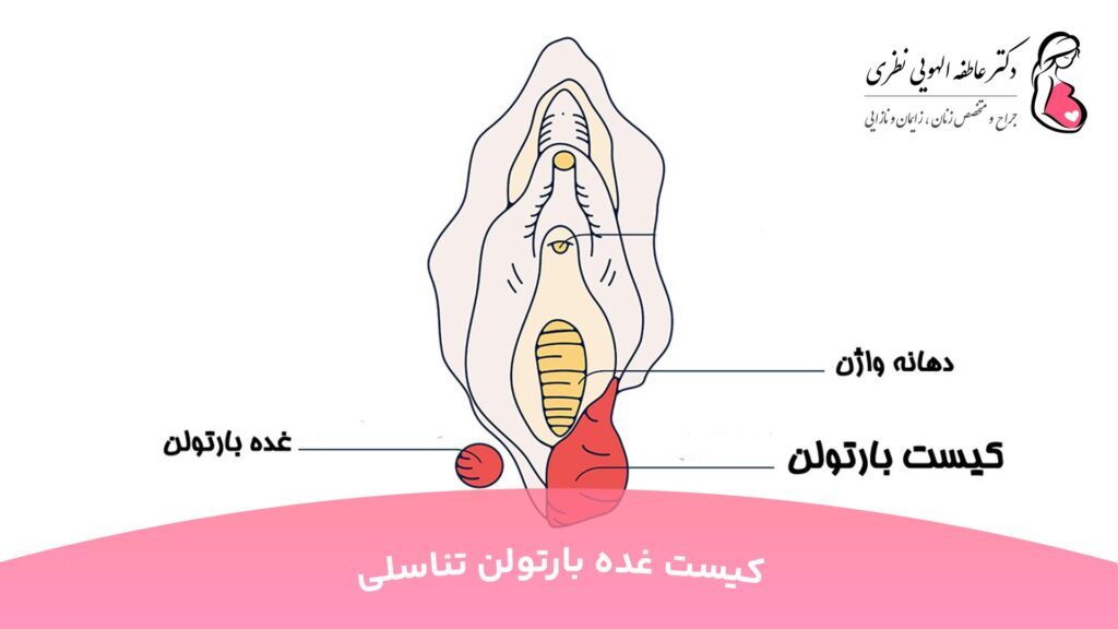 کیست غده بارتولن تناسلی