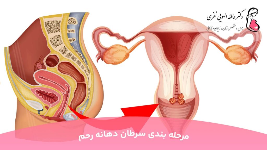 مرحله بندی سرطان دهانه رحم