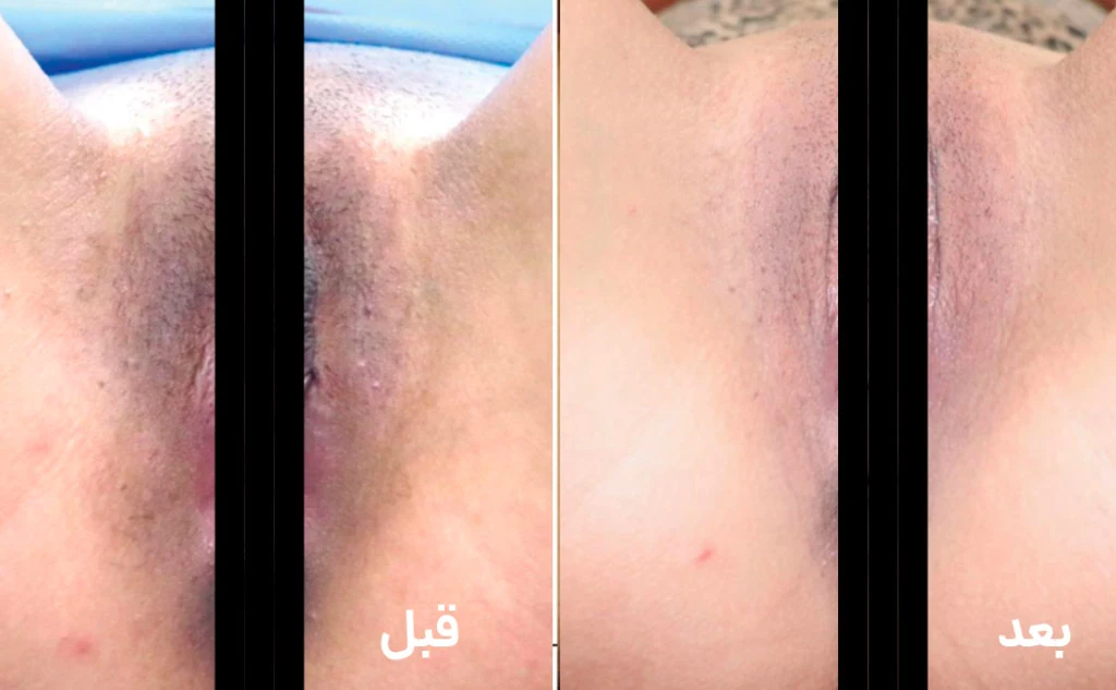 قبل و بعد از روش سازی واژن