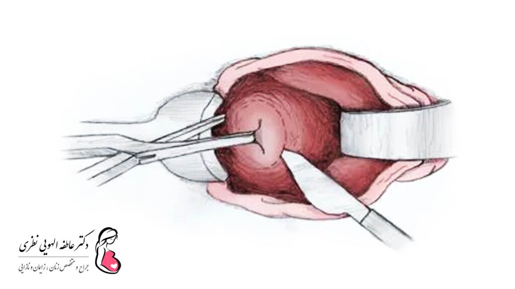 جراحی هیسترکتومی واژینال یا برداشتن رحم از طریق واژن