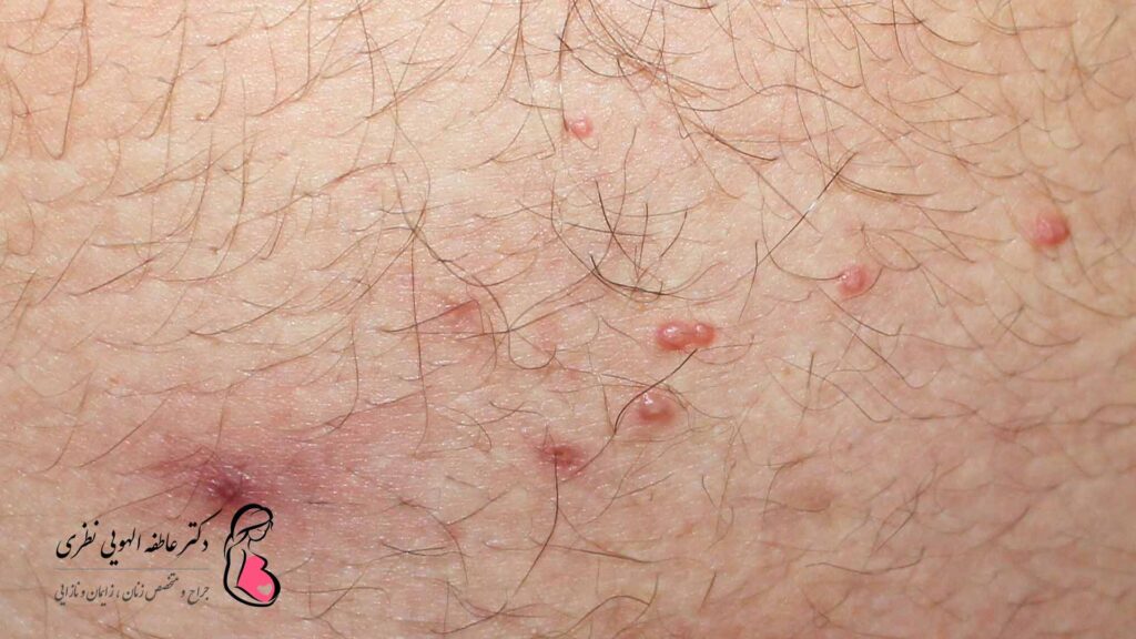 عکس بیماریهای پوستی دستگاه تناسلی زنان