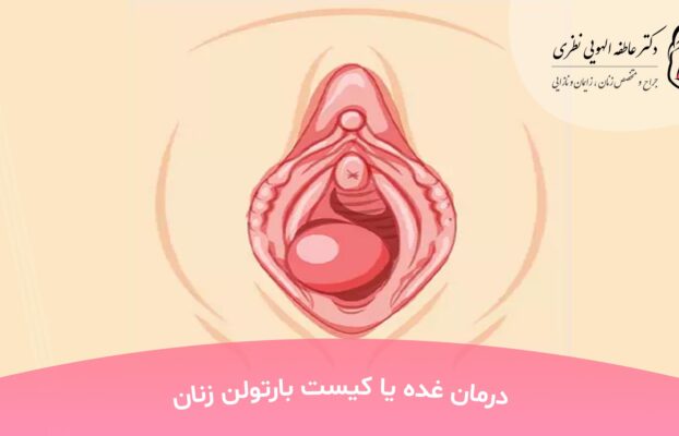 درمان غده یا کیست بارتولن زنان