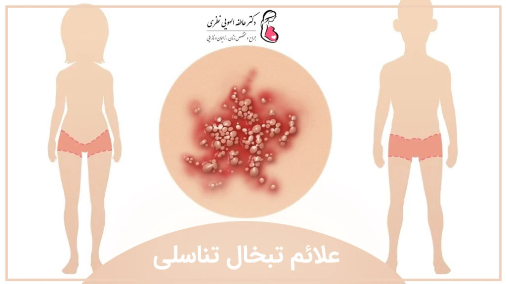 علائم و نشانه های تبخال تناسلی زنان و مردان