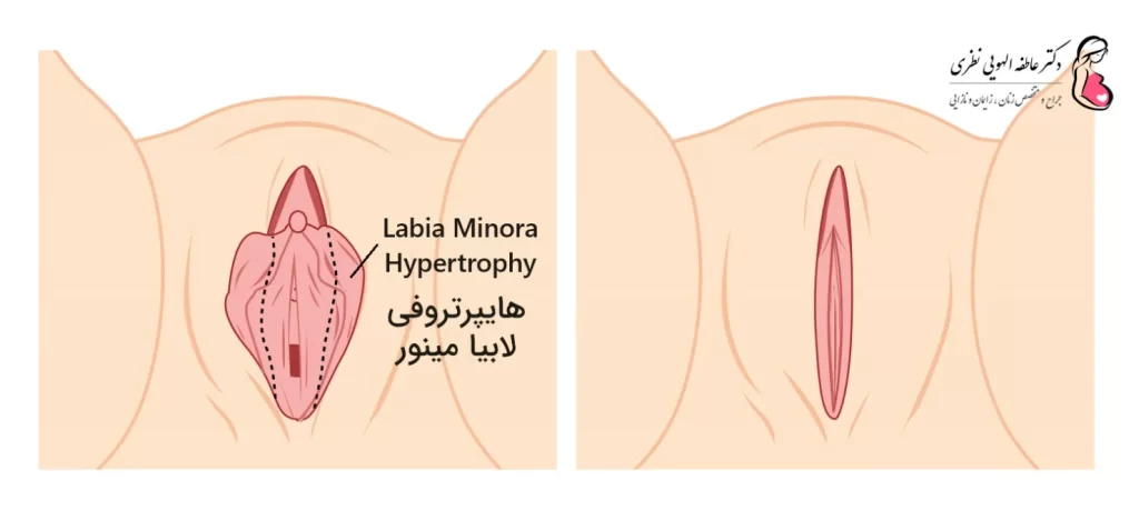 هایپرتروفی لابیا مینور