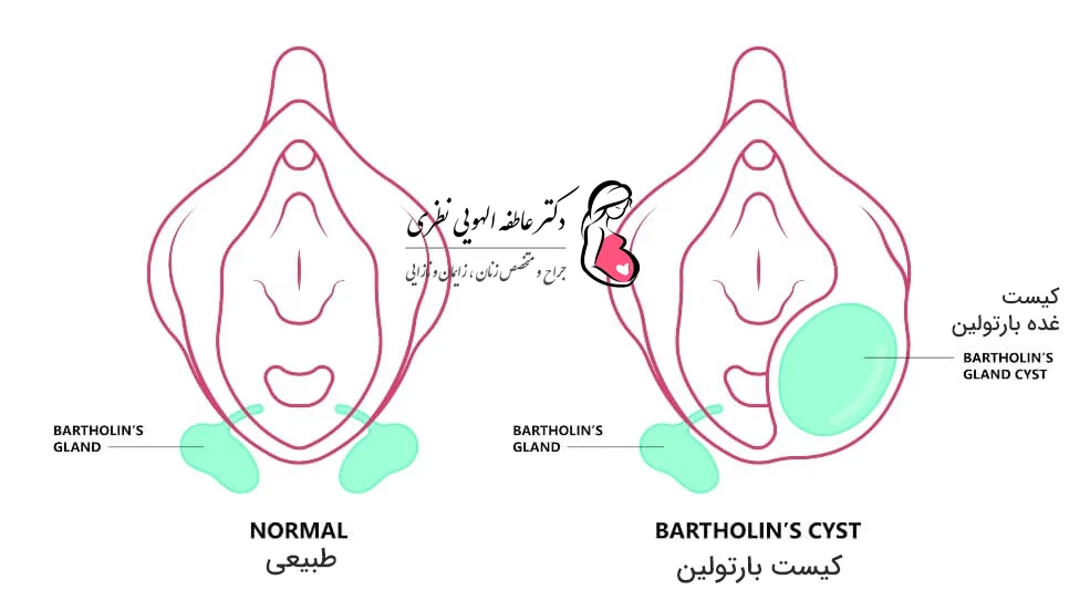 کیست بارتولین