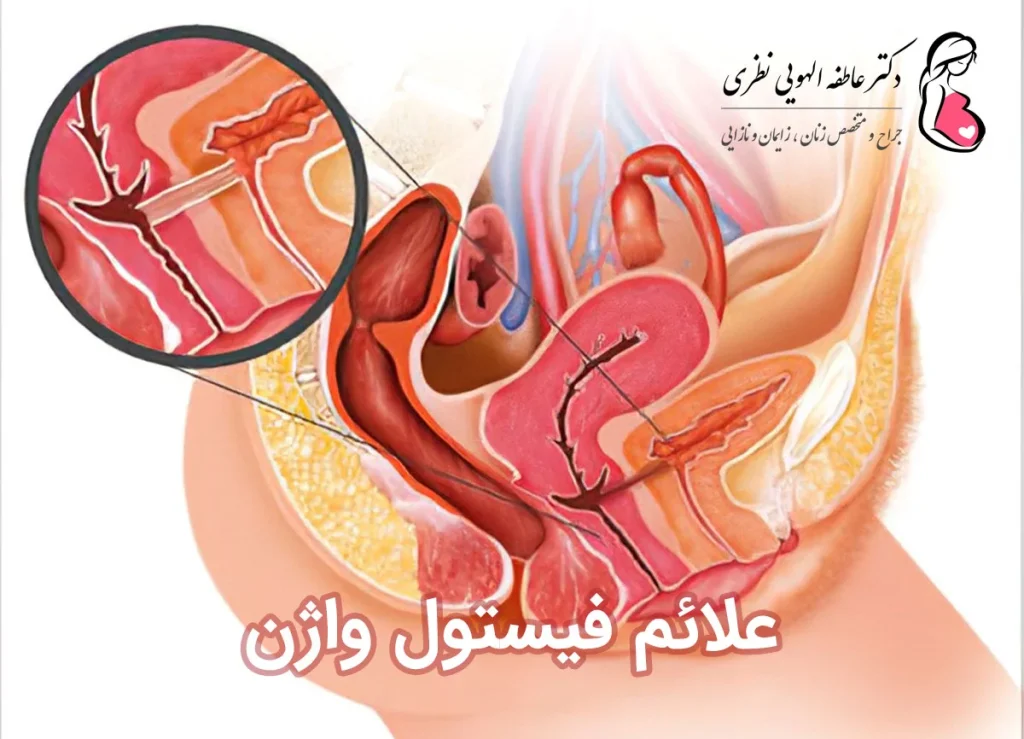 نشانه های فیستول واژن